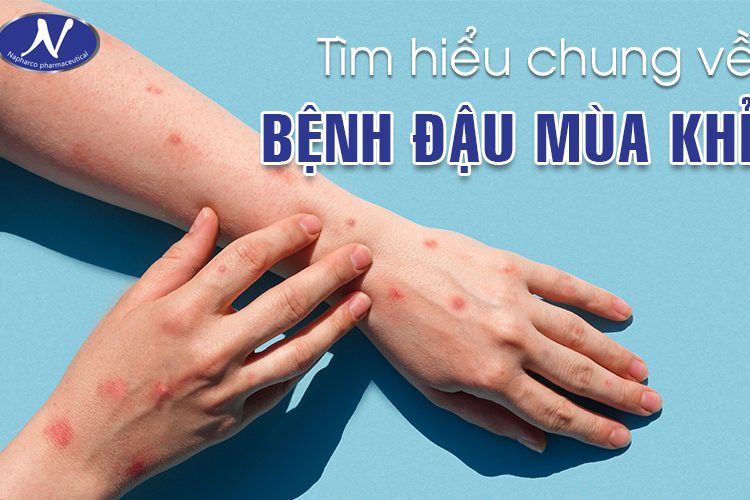 BỆNH ĐẬU MÙA KHỈ