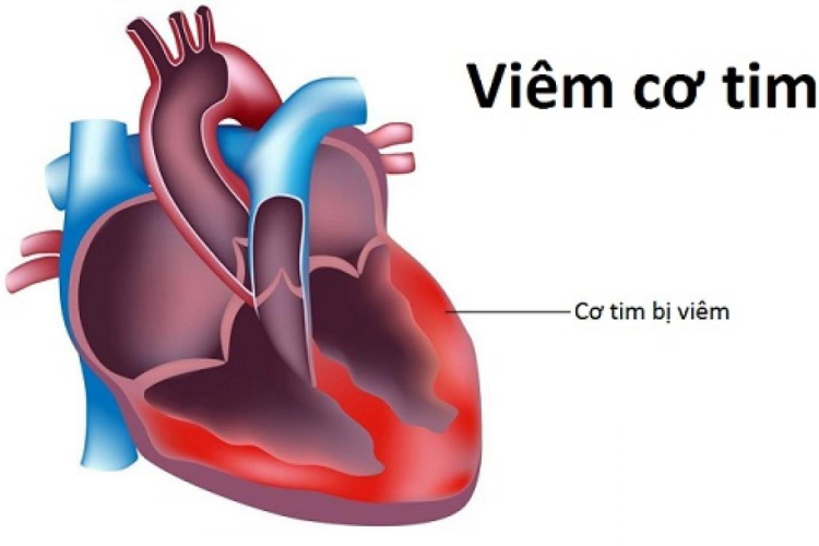 Một số bệnh thường gặp của Tim  