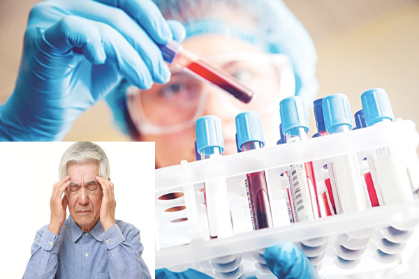 Xét nghiệm máu bệnh Alzheimer giúp chẩn đoán sớm bệnh
