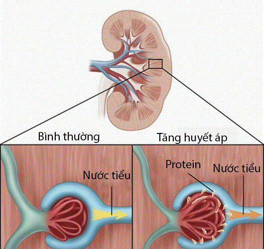 Thận và huyết áp