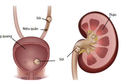 Urinary-kidney stones disease