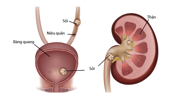 Bệnh sỏi thận-tiết niệu