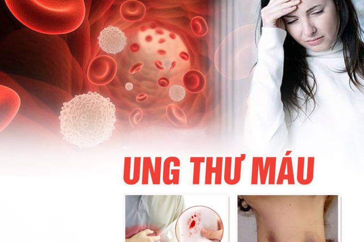 Bệnh ung thư máu cấp tính