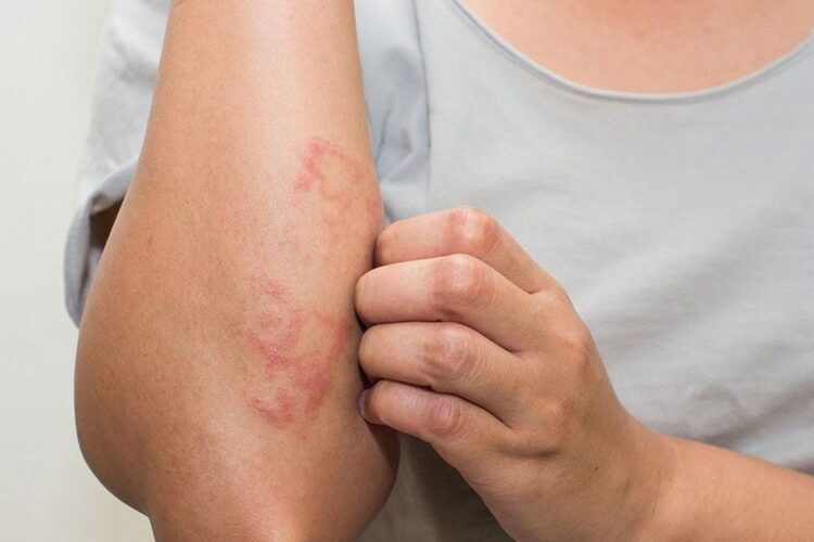 BỆNH VIÊM DA TIẾP XÚC