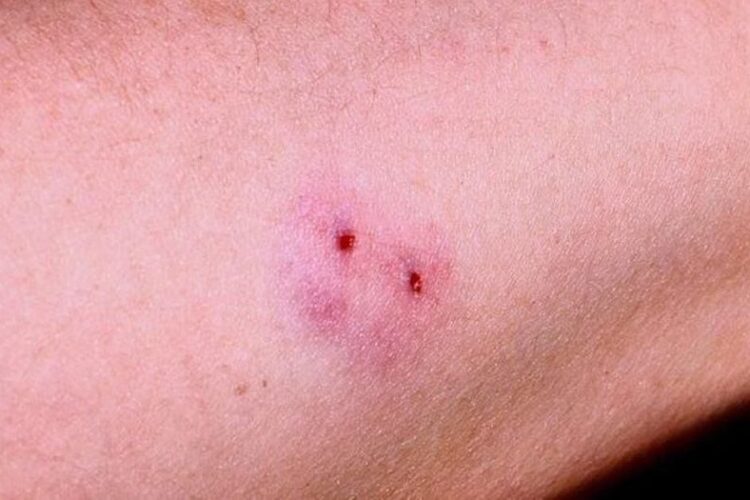 XỬ TRÍ RẮN CẮN