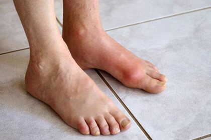 BỆNH GOUT VÀ CÁCH PHÒNG
