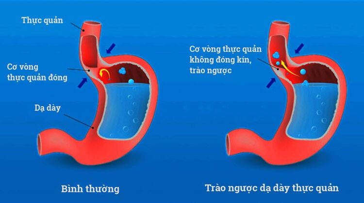 TRÀO NGƯỢC DẠ DÀY, THỰC QUẢN