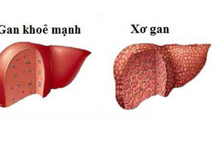 BỆNH XƠ GAN