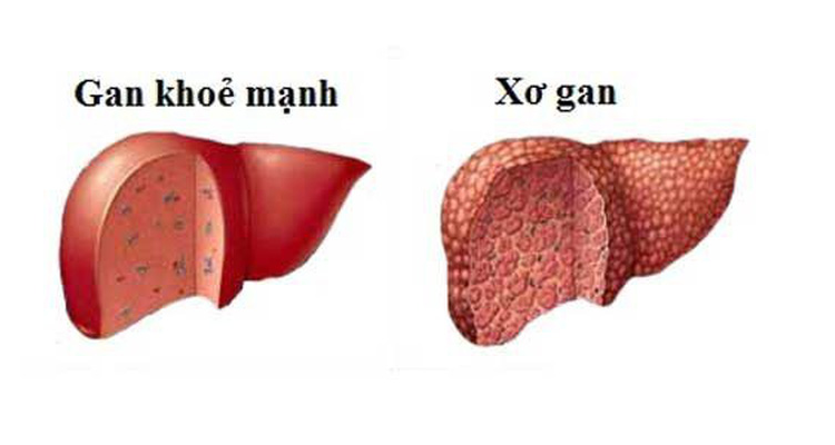 BỆNH XƠ GAN