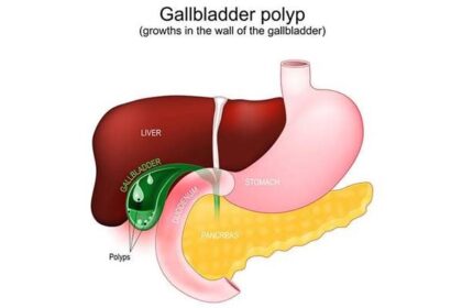 BỆNH POLYP TÚI MẬT