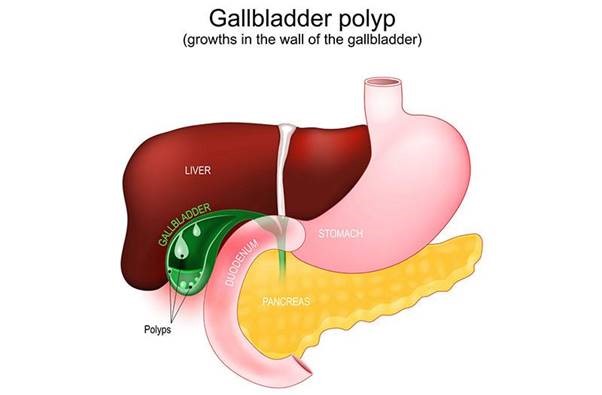 BỆNH POLYP TÚI MẬT