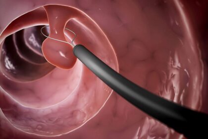 BỆNH POLYP ĐẠI TRỰC TRÀNG