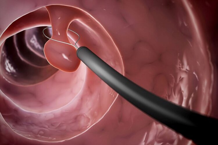 BỆNH POLYP ĐẠI TRỰC TRÀNG