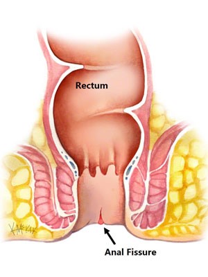 BỆNH NỨT HẬU MÔN