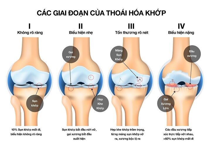 BỆNH THOÁI HOÁ KHỚP