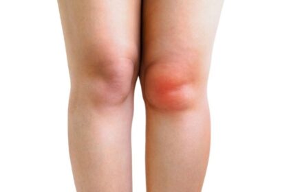 BỆNH TRÀN DỊCH KHỚP