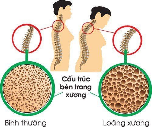 BỆNH LOÃNG XƯƠNG