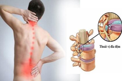 BỆNH THOÁT VỊ ĐĨA ĐỆM
