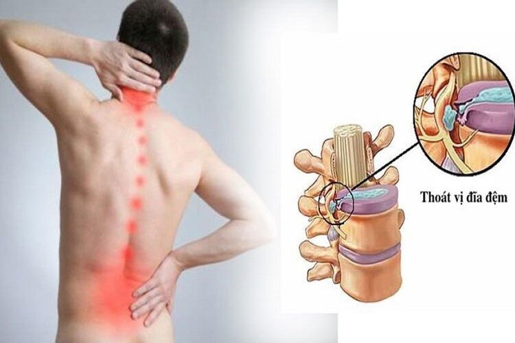 BỆNH THOÁT VỊ ĐĨA ĐỆM