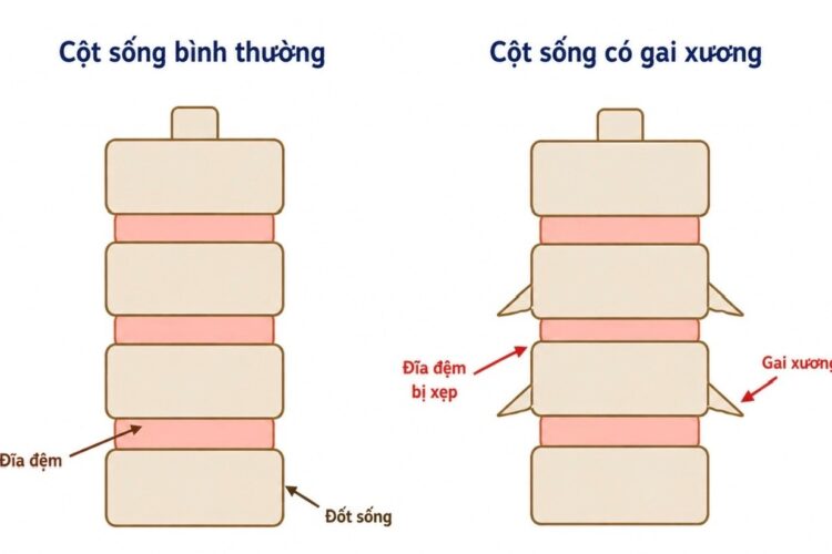 BỆNH GAI CỘT SỐNG